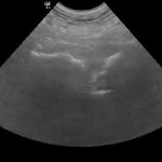 Ultrasound image of the symphysis pubis