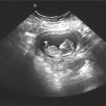 Снимок УЗИ 10 недель беременности