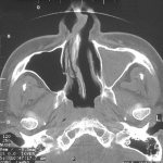 Total filling of the left maxillary sinus with fluid (blood?), damage to the nasal septum on a computed tomogram