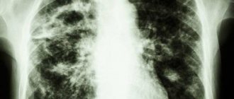 Туберкулёз флюорографией не выявить