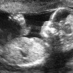 Ultrasound at 12 weeks of pregnancy
