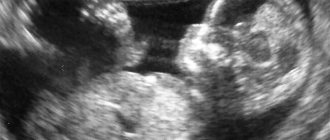 Ultrasound at 12 weeks of pregnancy