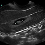 Vaginal ultrasound