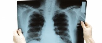 doctor holding a picture of the lungs in his hands