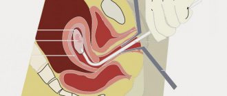 Discharge after cervical biopsy