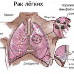 Malignant neoplasm of the lungs